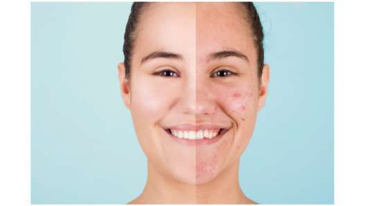 descubre tratamientos efectivos para el acné en adultos utilizando ácido azelaico y niacinamida, ingredientes que ayudan a reducir imperfecciones, controlar la producción de grasa y mejorar la apariencia de la piel.