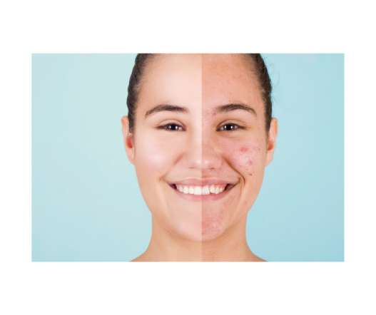 descubre tratamientos efectivos para el acné en adultos utilizando ácido azelaico y niacinamida, ingredientes que ayudan a reducir imperfecciones, controlar la producción de grasa y mejorar la apariencia de la piel.