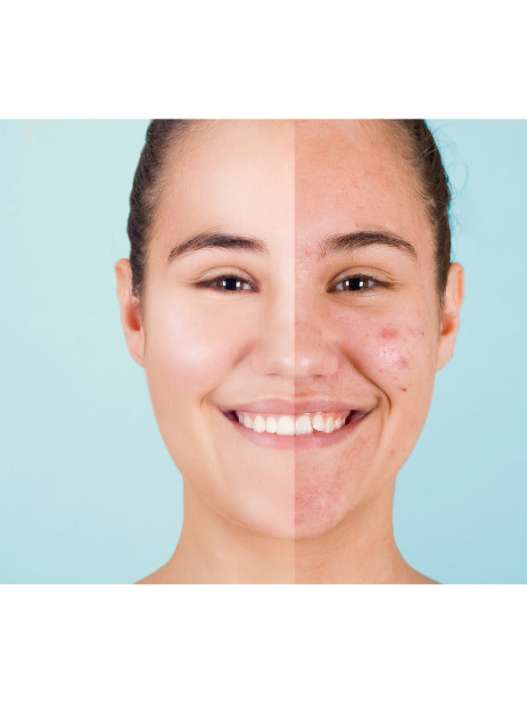 descubre tratamientos efectivos para el acné en adultos utilizando ácido azelaico y niacinamida, ingredientes que ayudan a reducir imperfecciones, controlar la producción de grasa y mejorar la apariencia de la piel.